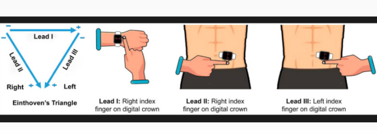 研究表明蘋果 Apple Watch 具有潛在檢測心臟病發作的能力